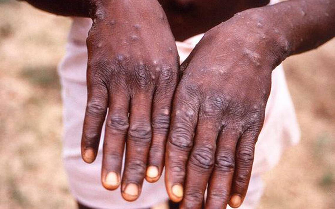 Canada records 77 cases of monkeypox